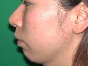 A small chin causes the face to be out of balance and makes the nose look large.